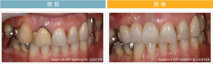 【51歳女性】　3本のオールセラミック治療で歯並びも改善