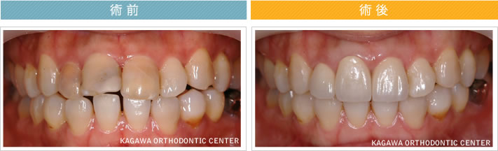 【29歳女性】　3本のオールセラミック治療で歯並びも改善
