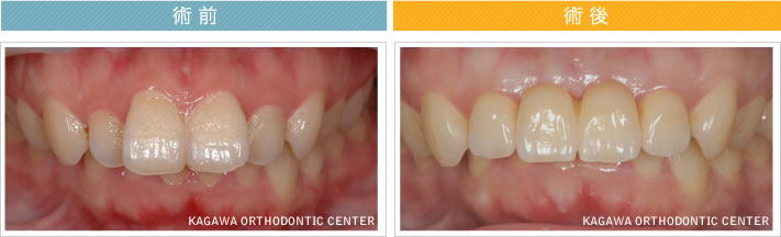 【37歳女性】　4本のオールセラミック治療で歯並びも改善