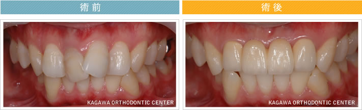 【23歳女性】　4本のオールセラミック治療で歯並びも改善