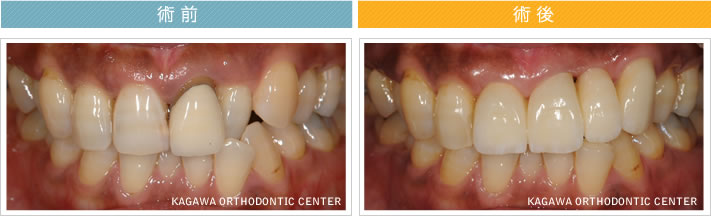 【39歳女性】　4本のオールセラミック治療で歯並びも改善