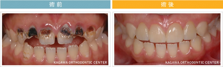 【21歳女性】　4本のオールセラミック治療で歯並びも改善