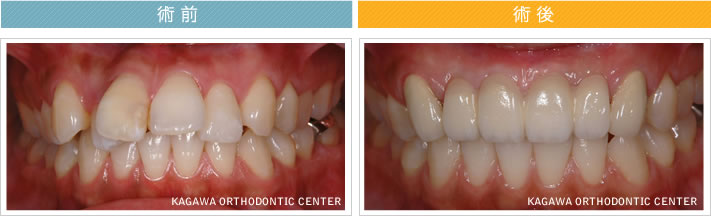 【28歳女性】　6本のオールセラミック治療で歯並びも改善