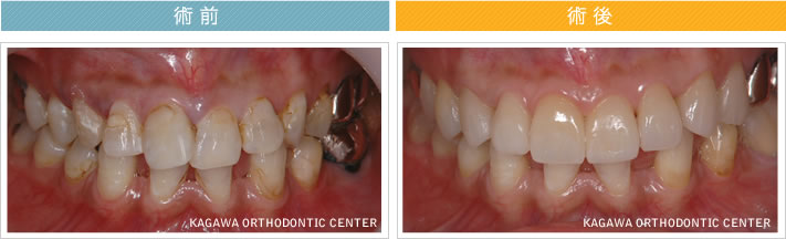 【41歳女性】　8本のオールセラミック治療で歯並びも改善