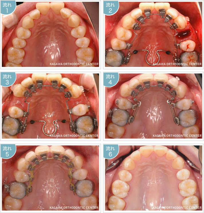 舌側（裏側）矯正治療の流れ