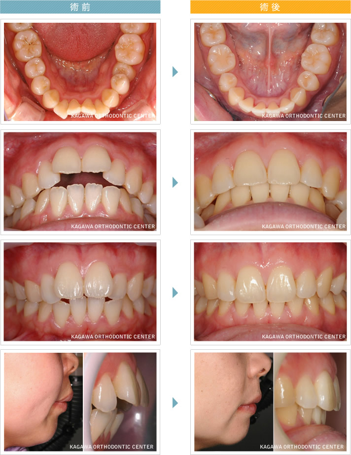 before ＆ after　ミホさん（仮名）成人 【上顎前突】