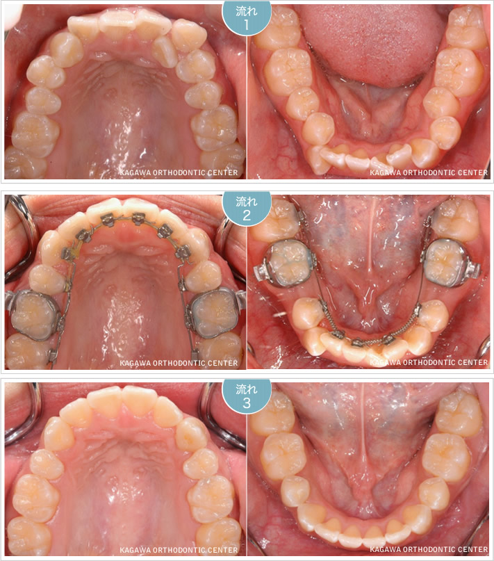 マキコさん（仮名）成人 【叢生の治療の実際】舌側（裏側）矯正治療の流れ