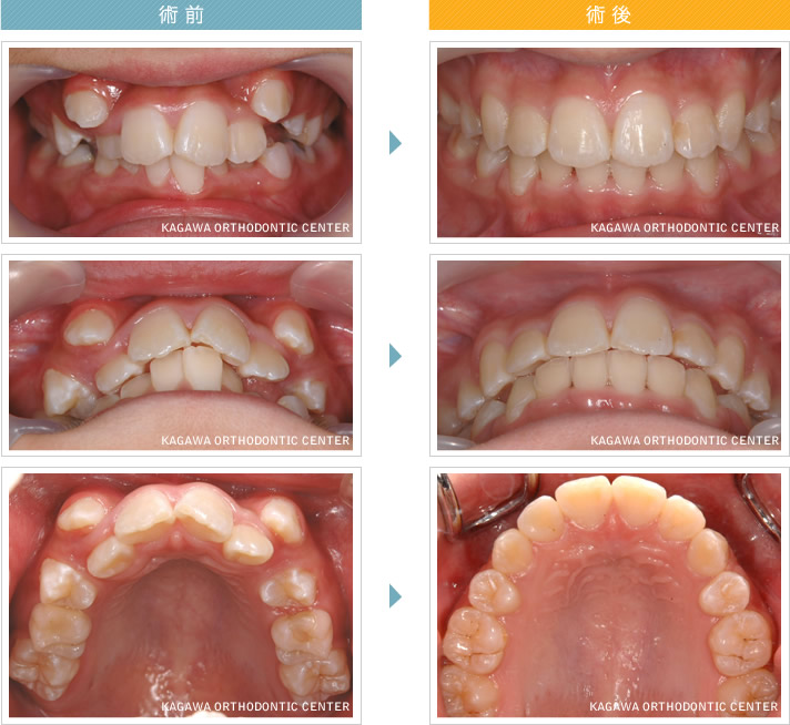 CASE1:ナナちゃん（仮名）小児 【八重歯の治療の実際】before ＆ after　ナナ（仮名） 【八重歯】