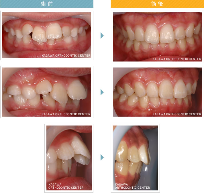 CASE2:　ヒロトくん（仮名）小児 【出っ歯の治療の実際】before ＆ afterヒロト（仮名） 【出っ歯】