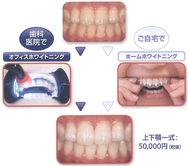 歯科医院でオフィスホワイトニング ご自宅でホームホワイトニング