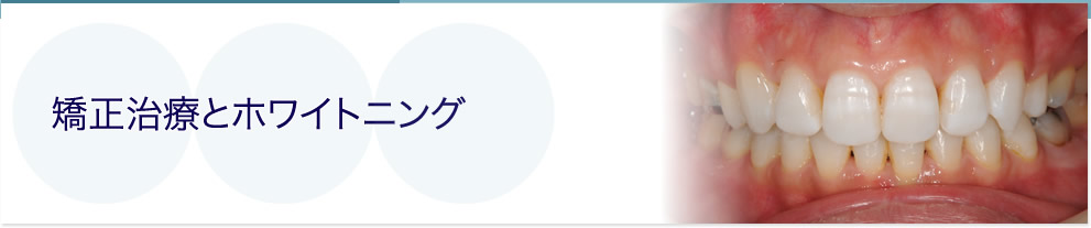 矯正治療とホワイトニング